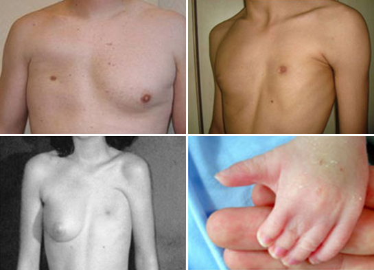 pektus poland sendromu