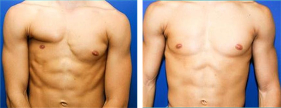 pektus poland sendromu